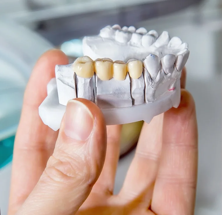 Dental Bridge Model