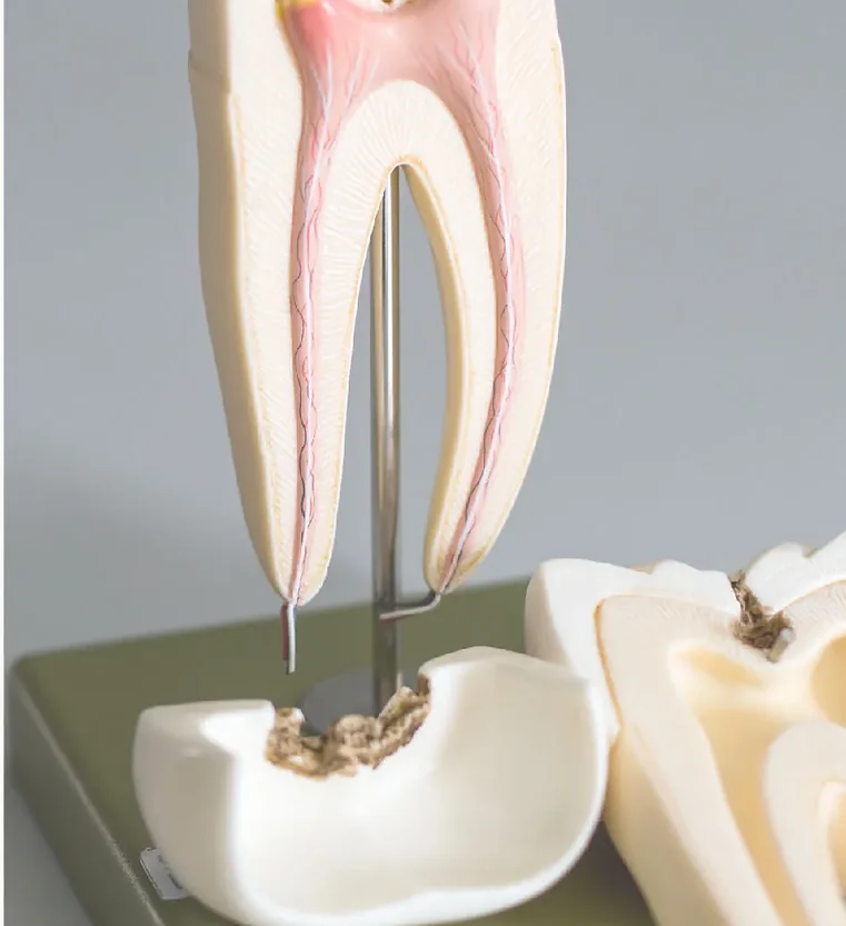 Root Canal Treatment Model