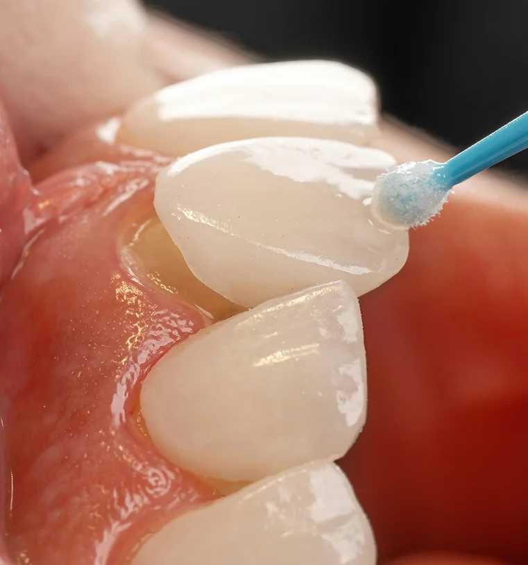 Tooth Being Cleaned